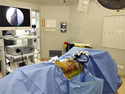 Percutaneous Transforaminal Endoscopic Decompression for Lumbar Lateral Recess Stenosis